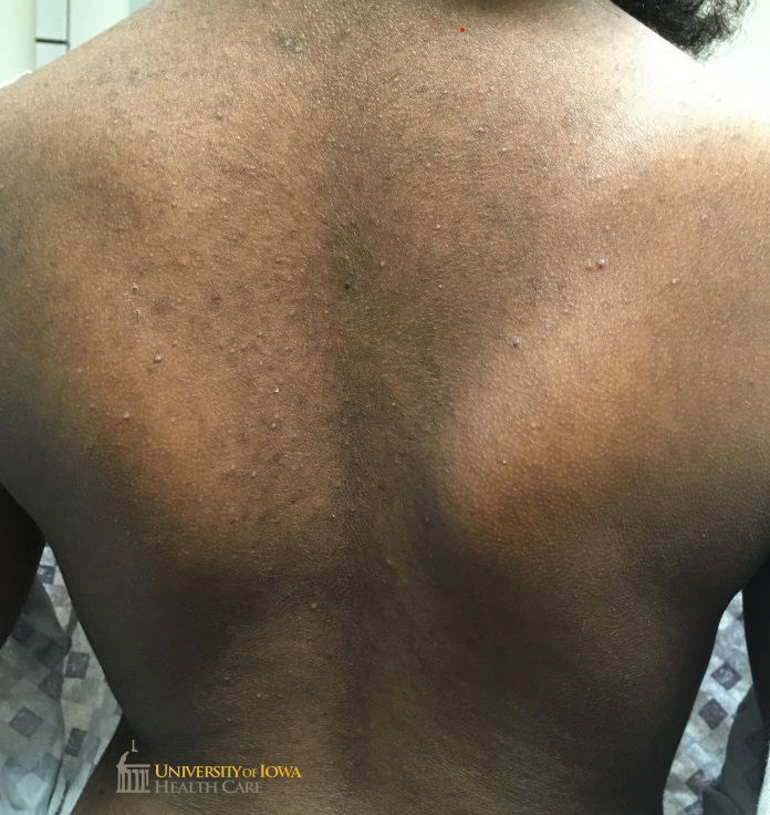 Widespread hyperpigmented scaly papules and the back. (click images for higher resolution).